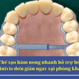 MARPE: kỹ thuật nong hàm hỗ trợ minivis cho bệnh nhân trưởng thành - Minvisss