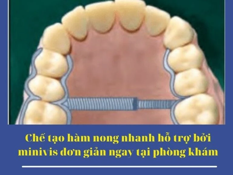 MARPE: kỹ thuật nong hàm hỗ trợ minivis cho bệnh nhân trưởng thành - Minvisss