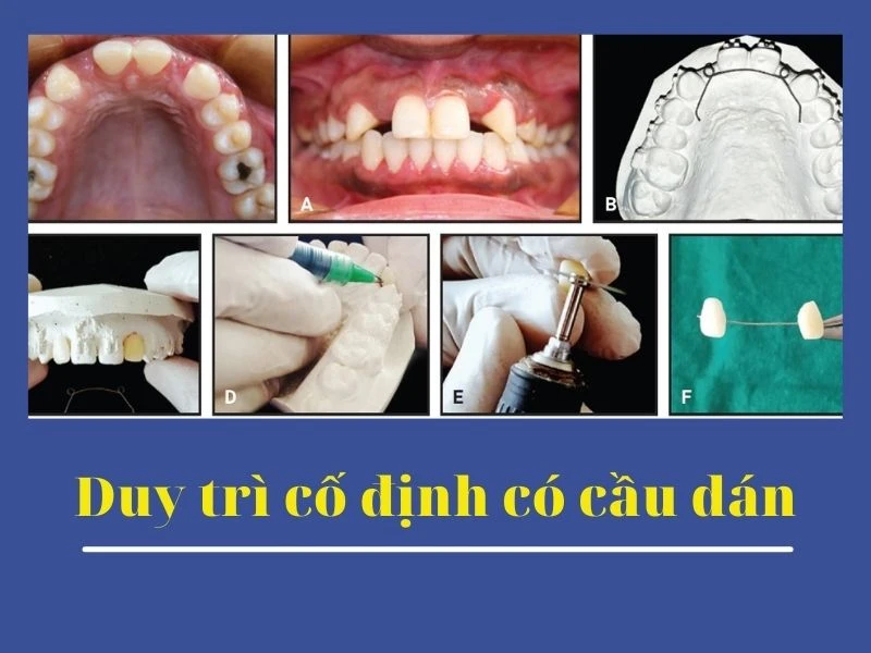 Duy trì cố định có cầu dán