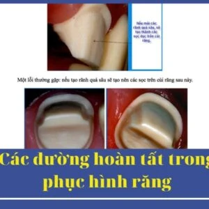 Các đường hoàn tất trong phục hình răng - nâng cao - Duong hoan thien