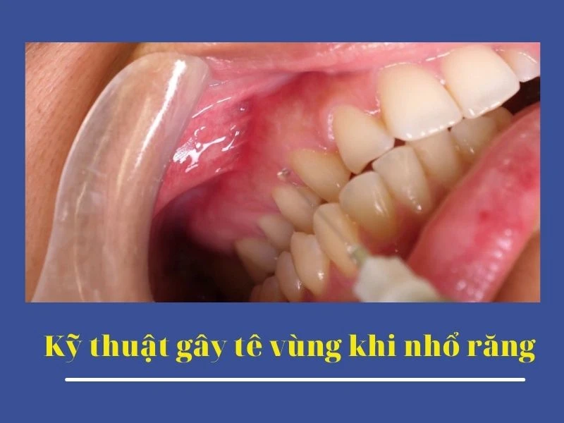 Kỹ thuật gây tê vùng khi nhổ răng - phương pháp 2 - Gay te