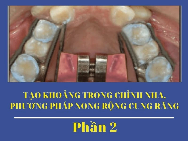 Tạo khoảng trong chỉnh nha, phương pháp nong rộng cung răng phần 2