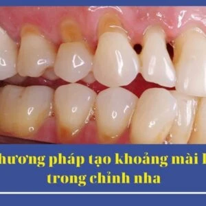 Phương pháp tạo khoảng mài kẽ trong chỉnh nha - Tao ke rang