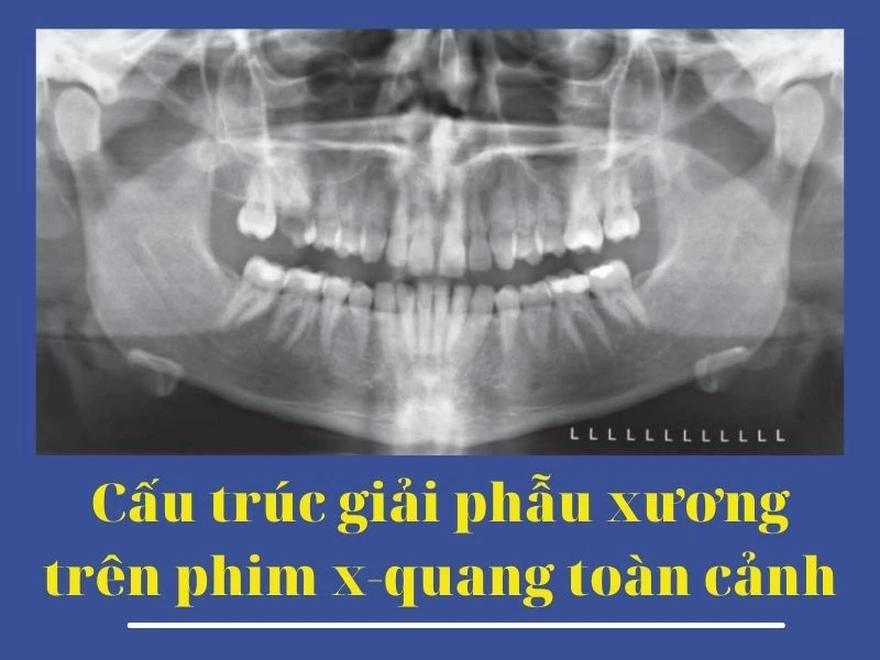 Cấu trúc giải phẫu xương trên phim X-quang toàn cảnh