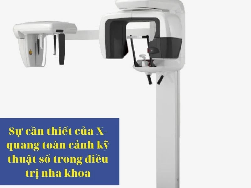 Sự cần thiết của X-quang toàn cảnh kỹ thuật số trong điều trị nha khoa