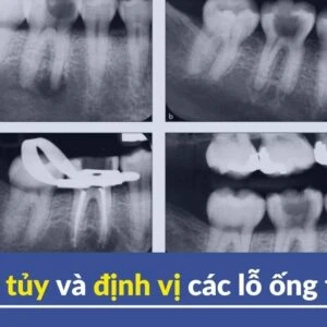 Mở tủy và định vị các lỗ ống tủy - Mo tuy va dinh vi cac lo ong tuy