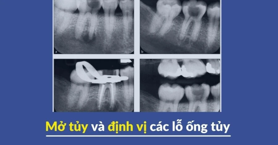 Mở tủy và định vị các lỗ ống tủy