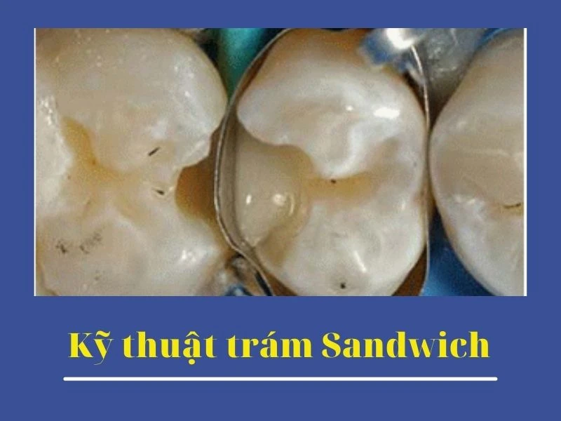 Kỹ thuật trám sandwich