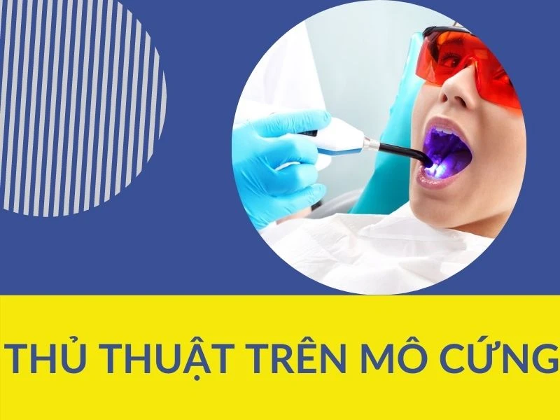 Phẫu thuật trong chỉnh nha (p2) – thủ thuật trên mô cứng