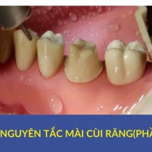 Các nguyên tắc mài cùi răng (phần 1) - PHAN 1 CUI RANG