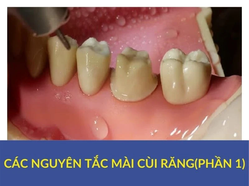 Các nguyên tắc mài cùi răng (phần 1)