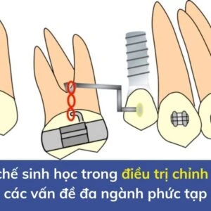 Cơ chế sinh học trong điều trị chỉnh nha các vấn đề đa ngành phức tạp - Chinh nha