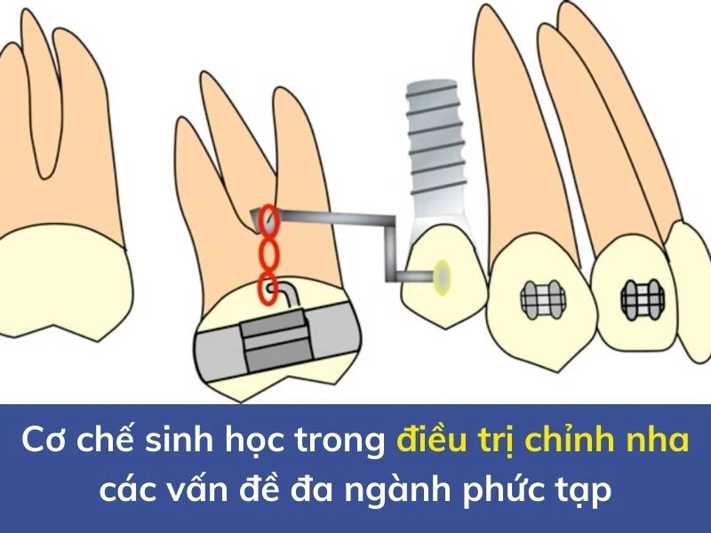 Cơ chế sinh học trong điều trị chỉnh nha các vấn đề đa ngành phức tạp