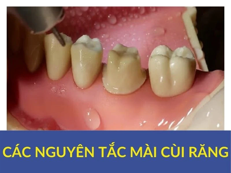 Các nguyên tắc mài cùi răng (phần cuối) - Mai cui rang