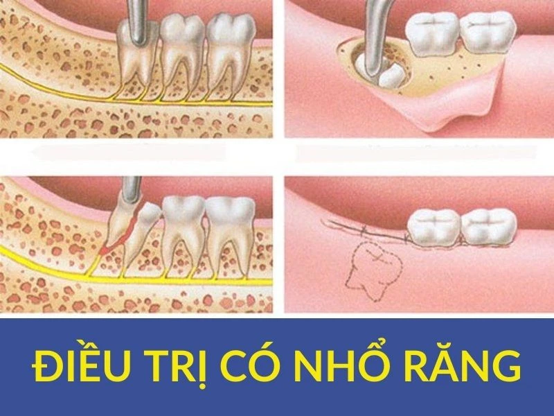 Series tự học chỉnh nha: điều trị có nhổ răng - lý thuyết - Co nho rang