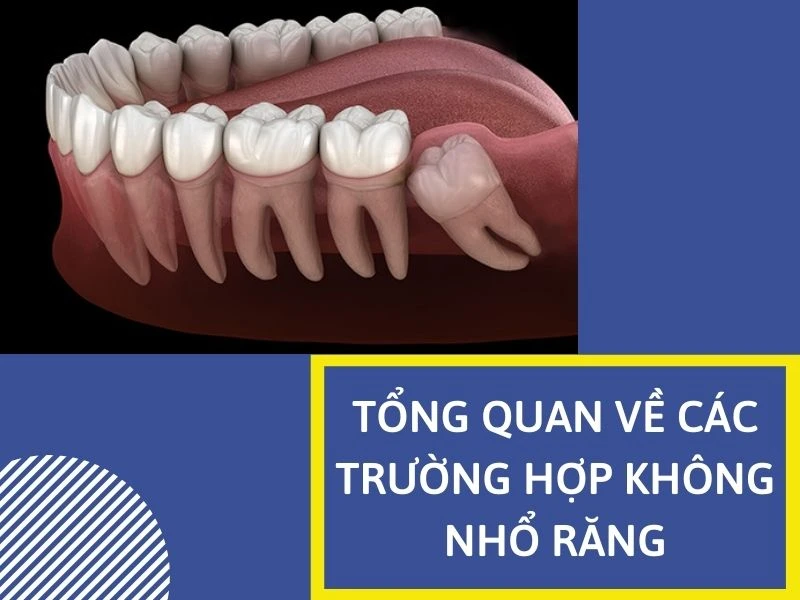 Series tự học chỉnh nha: tổng quan về các trường hợp không nhổ răng – case study