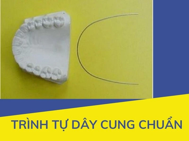 Series tự học chỉnh nha: trình tự dây cung chuẩn