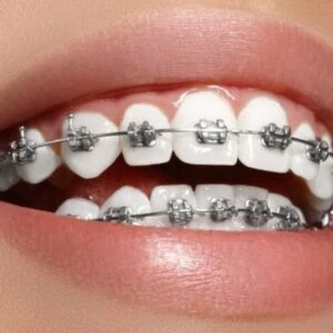 Series tự học chỉnh nha: các hệ thống mắc cài - phần 2 - Mac cai