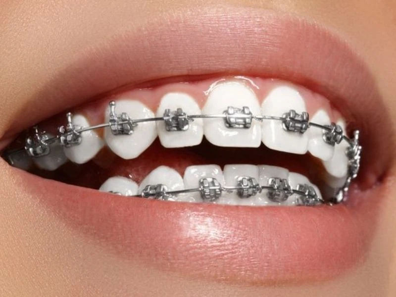 Series tự học chỉnh nha: các hệ thống mắc cài – phần 2