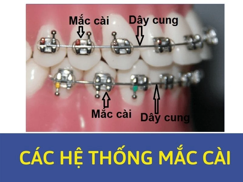 Series tự học chỉnh nha: các hệ thống mắc cài – phần 1