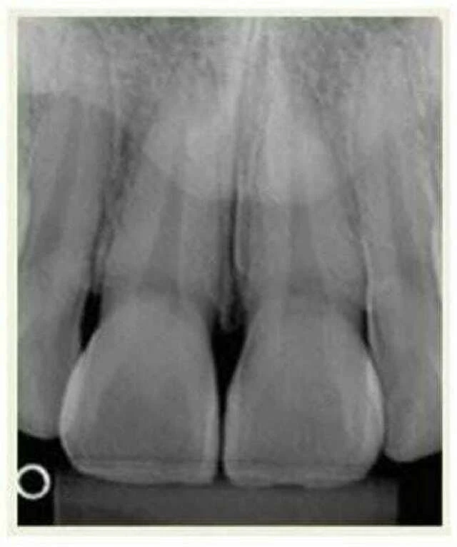 Phim cận chóp răng cửa dưới và trên
