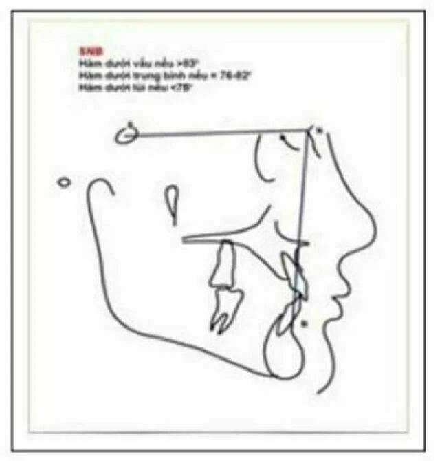 phim sọ nghiêng - SNB