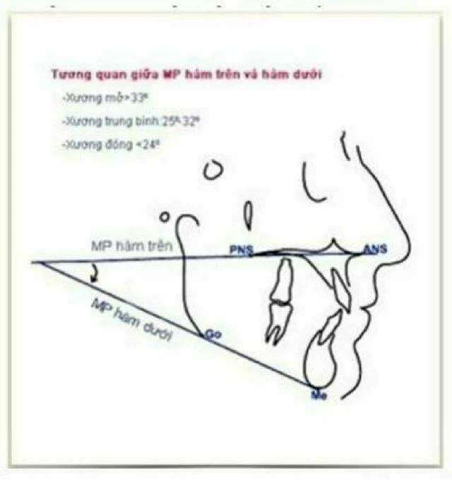 Góc giữa mặt phẳng hàm dưới và mặt phẳng hàm trên