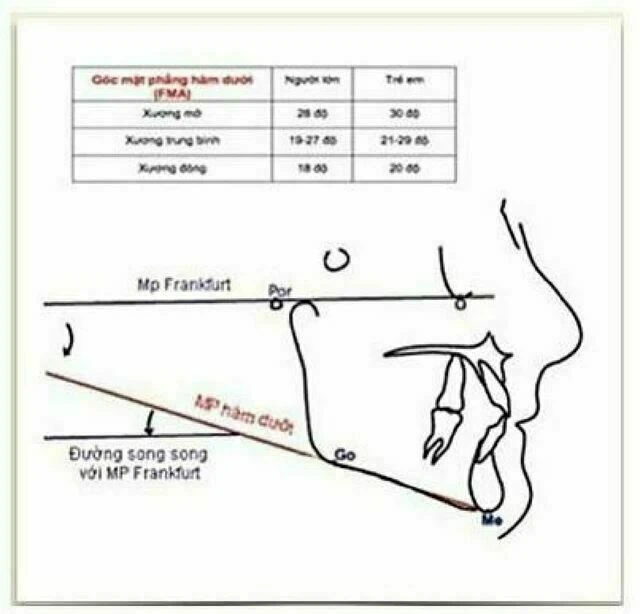 Các trường hợp xương đóng