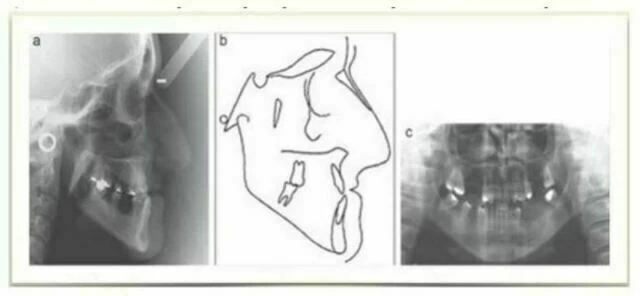 Các trường hợp xương mở