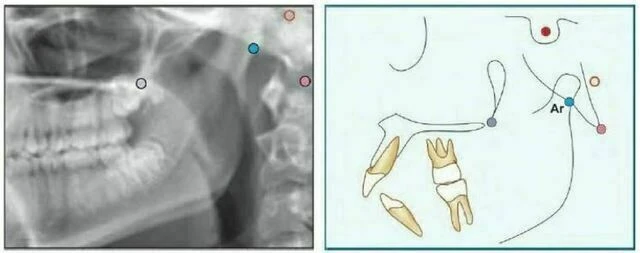xquang nha khoa - Articulare (Ar)