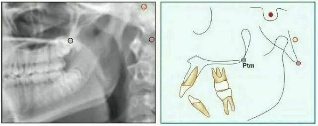 xquang nha khoa - Pterygomaxillary Fissure (Ptm)