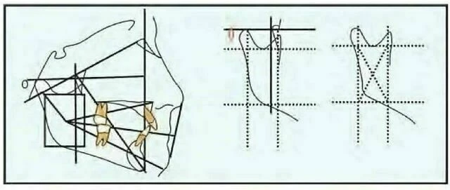 xquang nha khoa - Điểm Xi
