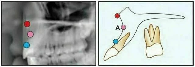 Subspinale (điểm “A”)