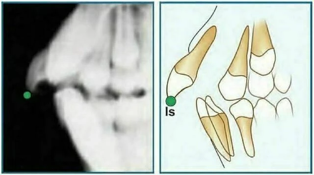 xquang nha khoa - Incision Superius (Is)