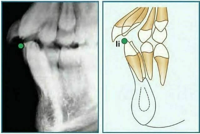 xquang nha khoa - Insision Inferius (Ii)