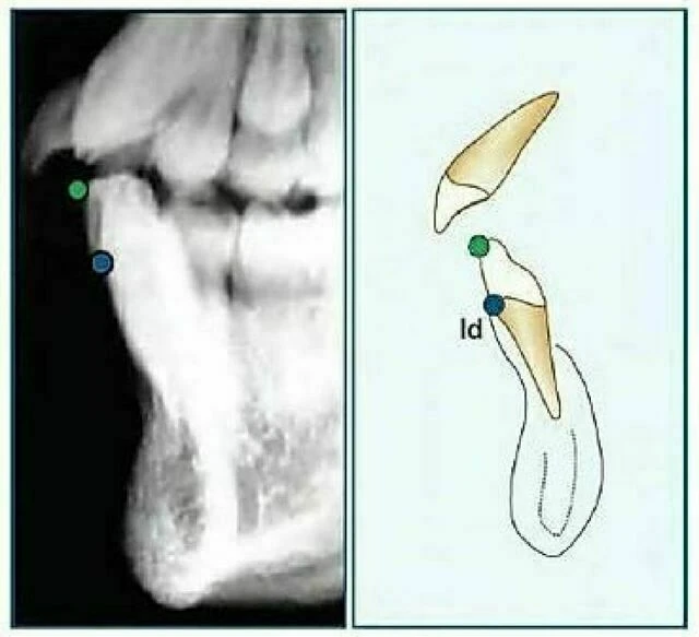 xquang nha khoa - Infradentale (Id)