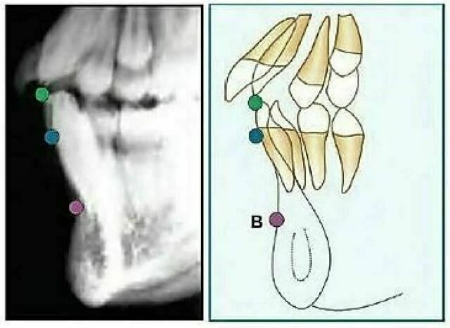xquang nha khoa - Supramentale (điểm “B”)