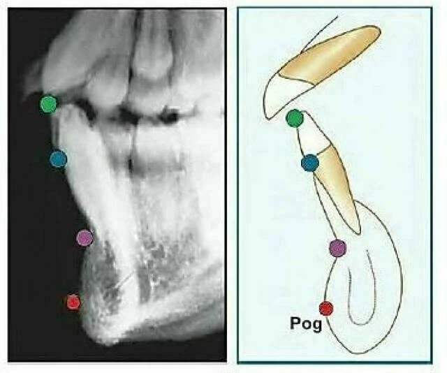 xquang nha khoa - Pogonion (Pog)