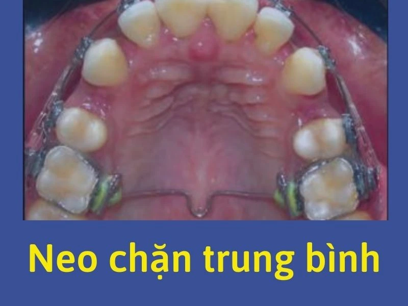 Series tự học chỉnh nha: neo chặn trung bình – kết quả