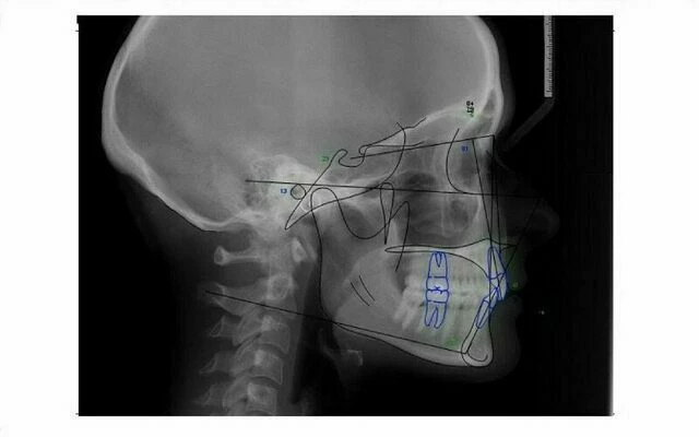 Phim Cephalometric