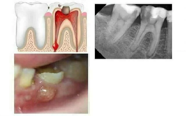 Bệnh lý mô quanh chóp