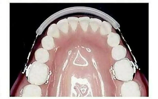 chỉnh nha không nhổ răng