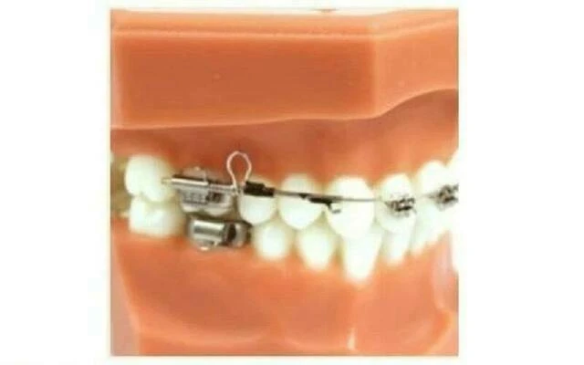 Cung di xa Wilson - Wilson Distalizing Arch