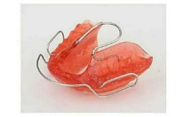 chỉnh nha không nhổ răng