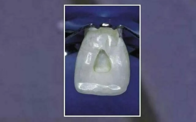 Hình dạng xoang tủy