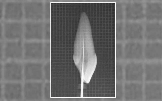 Xoang tủy khi hoàn thành