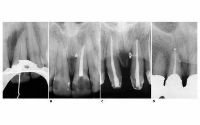 Phim trong lúc điều trị ở răng