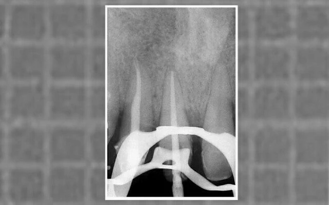 Phim trong lúc điều trị của răng cửa giữa