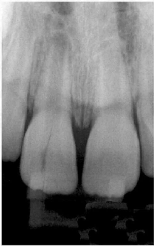 điều trị nội nha - nứt dọc chân răng