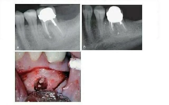 điều trị nội nha - nứt dọc chân răng